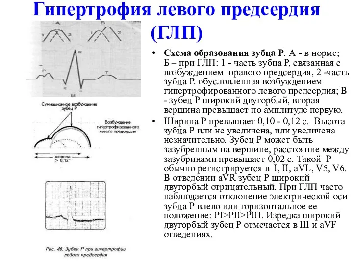 Гипертрофия левого предсердия (ГЛП) Схема образования зубца Р. А -