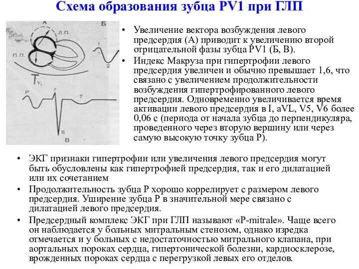 Схема образования зубца PV1 при ГЛП Увеличение вектора возбуждения левого