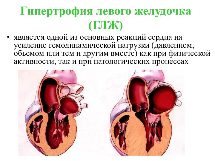 Гипертрофия левого желудочка (ГЛЖ) является одной из основных реакций сердца