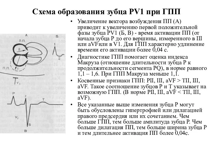Схема образования зубца PV1 при ГПП Увеличение вектора возбуждения ПП