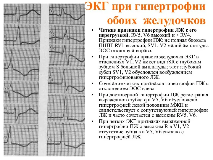 ЭКГ при гипертрофии обоих желудочков Четкие признаки гипертрофии ЛЖ с