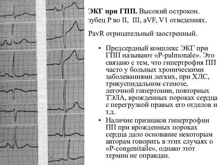 ЭКГ при ГПП. Высокий острокон. зубец Р во II, III,