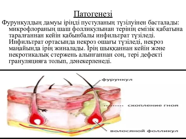 Патогенезі Фурункулдың дамуы іріңді пустуланың түзілуінен басталады: микрофлораның шаш фолликулынан