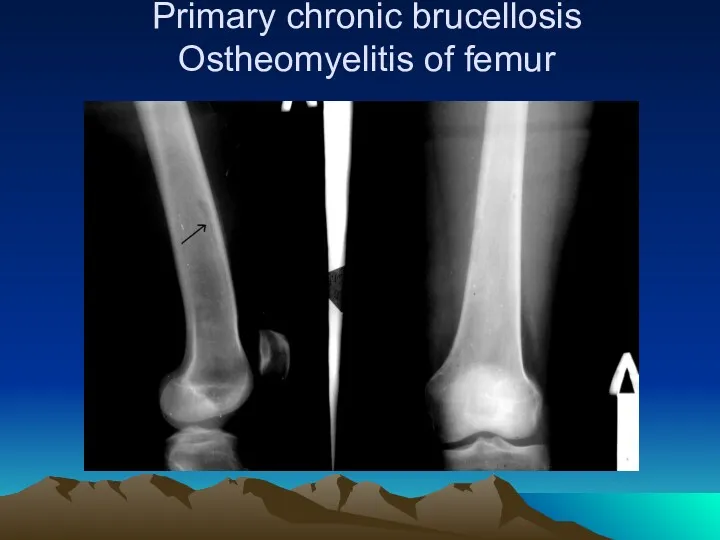 Primary chronic brucellosis Ostheomyelitis of femur