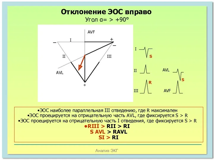 Анализ ЭКГ Отклонение ЭОС вправо Угол α= > +90° AVF