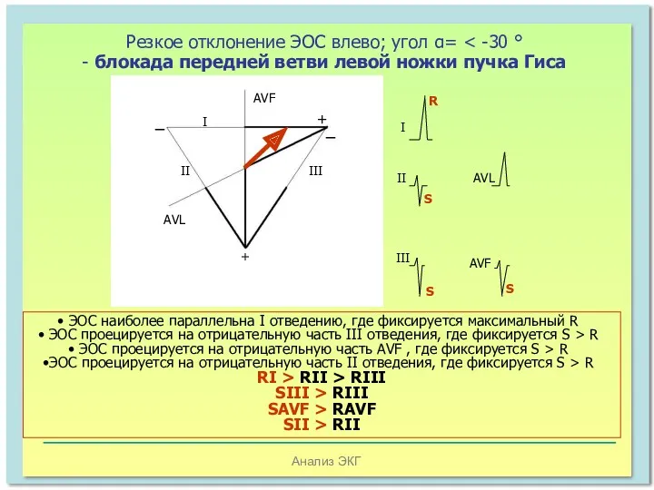 Анализ ЭКГ Резкое отклонение ЭОС влево; угол α= AVF AVL