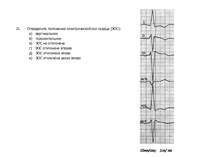 21. Определите положение электрической оси сердца (ЭОС): а) вертикальное б)