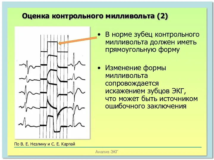 Анализ ЭКГ Оценка контрольного милливольта (2) В норме зубец контрольного