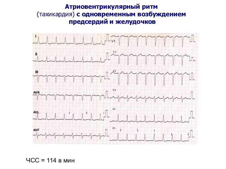 Атриовентрикулярный ритм (тахикардия) с одновременным возбуждением предсердий и желудочков ЧСС