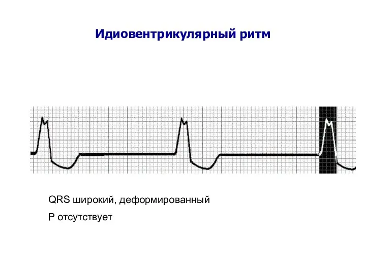 Идиовентрикулярный ритм QRS широкий, деформированный Р отсутствует