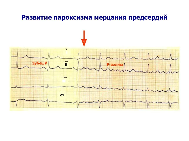 Развитие пароксизма мерцания предсердий I II III V1 Зубец Р F-волны