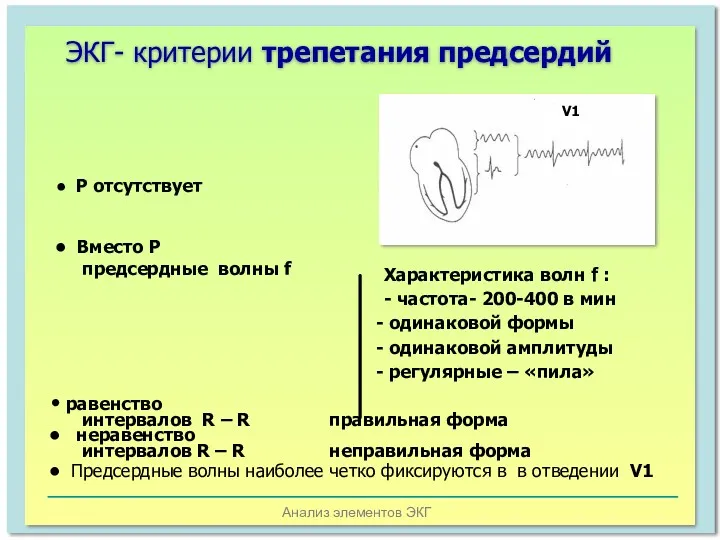 Анализ элементов ЭКГ ЭКГ- критерии трепетания предсердий V1 Характеристика волн