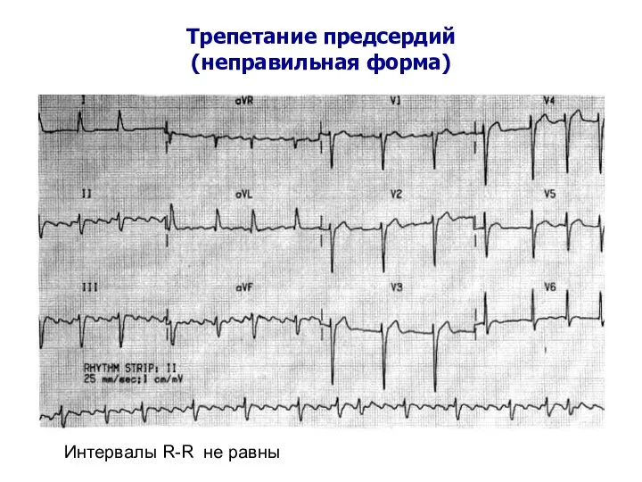 Трепетание предсердий (неправильная форма) Интервалы R-R не равны