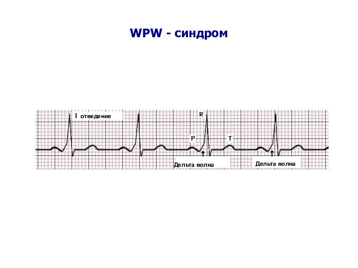 WPW - синдром I отведение Дельта волна Дельта волна