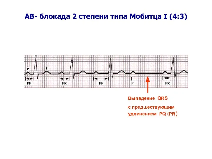 AВ- блокада 2 степени типа Мобитца I (4:3) Выпадение QRS c предшествующим удлинением PQ (PR)