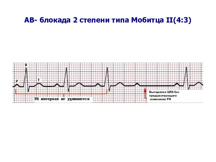 AВ- блокада 2 степени типа Мобитца II(4:3) Выпадение QRS без предшествующего изменения PR