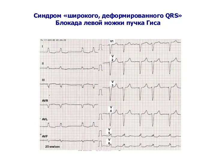 Синдром «широкого, деформированного QRS» Блокада левой ножки пучка Гиса I