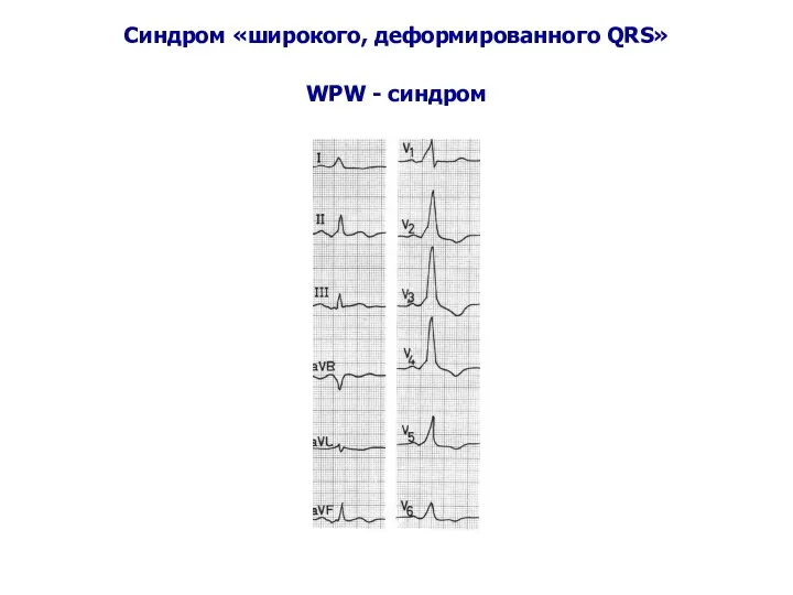 Синдром «широкого, деформированного QRS» WPW - синдром