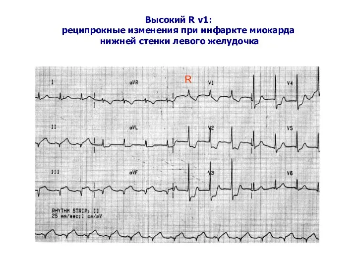 Высокий R v1: реципрокные изменения при инфаркте миокарда нижней стенки левого желудочка R
