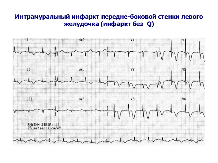Интрамуральный инфаркт передне-боковой стенки левого желудочка (инфаркт без Q)