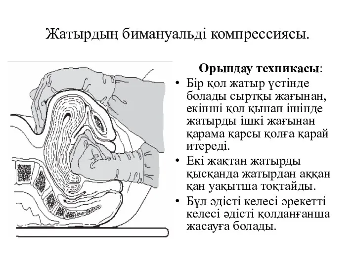 Жатырдың бимануальді компрессиясы. Орындау техникасы: Бір қол жатыр үстінде болады