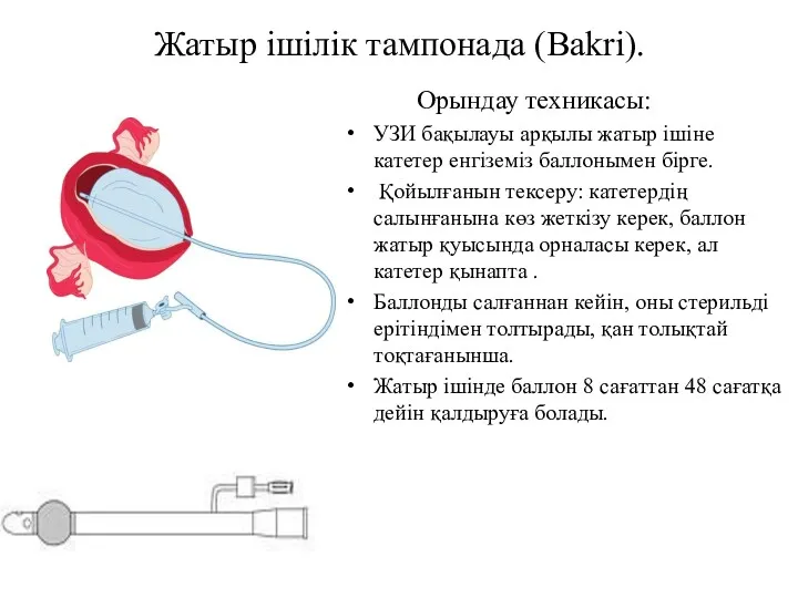 Жатыр ішілік тампонада (Bakri). Орындау техникасы: УЗИ бақылауы арқылы жатыр