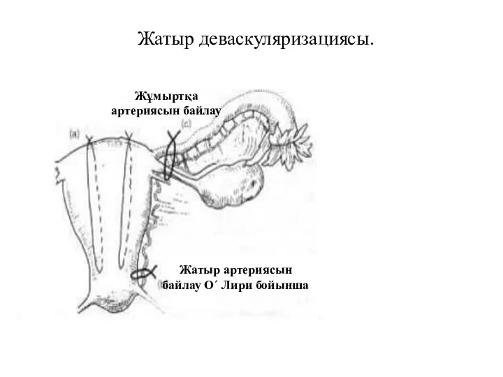 Жатыр деваскуляризациясы. Жұмыртқа артериясын байлау Жатыр артериясын байлау О´ Лири бойынша