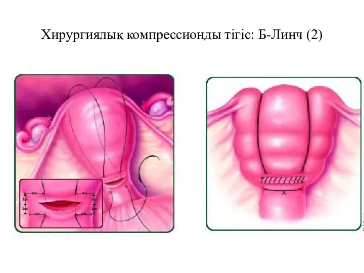 Хирургиялық компрессионды тігіс: Б-Линч (2)