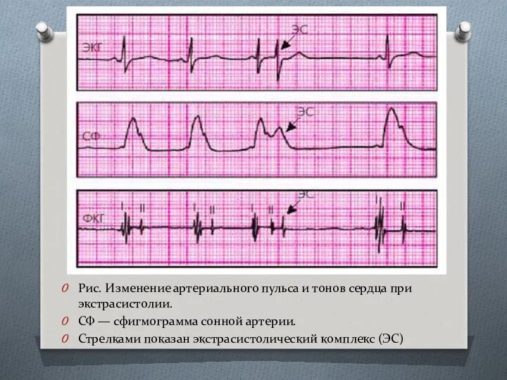 Рис. Изменение артериального пульса и тонов сердца при экстрасистолии. СФ