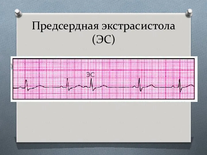 Предсердная экстрасистола (ЭС)