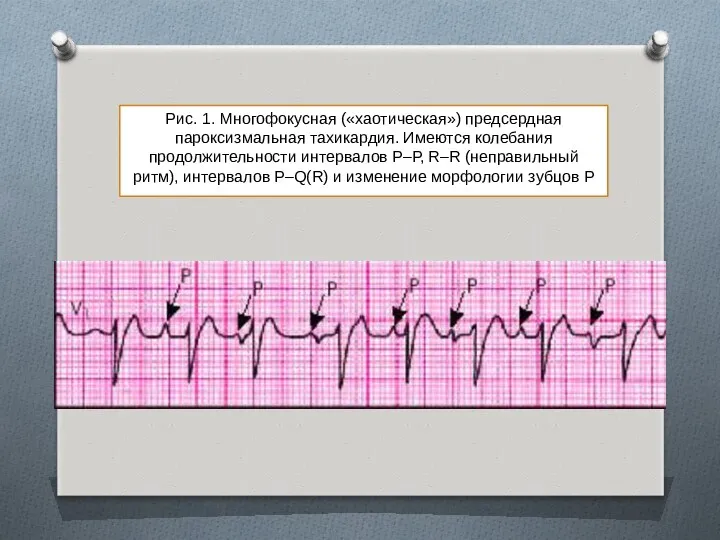 Рис. 1. Многофокусная («хаотическая») предсердная пароксизмальная тахикардия. Имеются колебания продолжительности