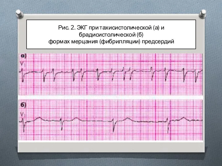 Рис. 2. ЭКГ при тахисистолической (а) и брадисистолической (б) формах мерцания (фибрилляции) предсердий