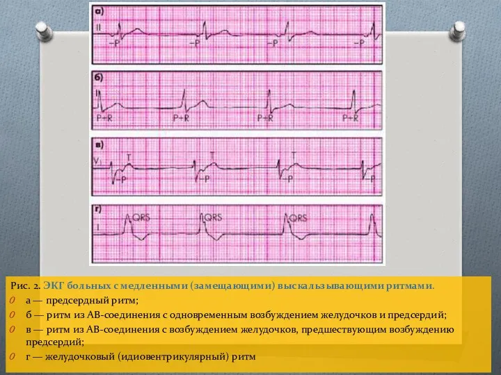 Рис. 2. ЭКГ больных с медленными (замещающими) выскальзывающими ритмами. а