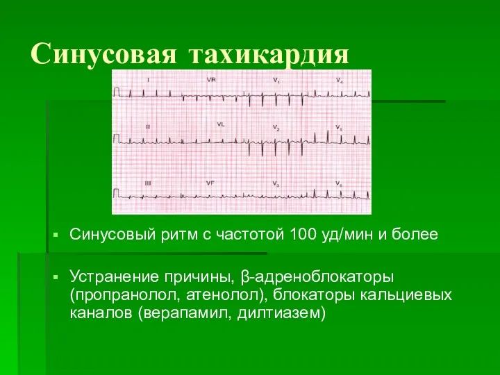 Синусовая тахикардия Синусовый ритм с частотой 100 уд/мин и более Устранение причины, β-адреноблокаторы