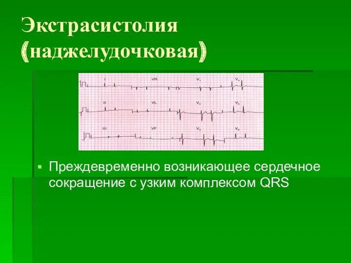 Экстрасистолия (наджелудочковая) Преждевременно возникающее сердечное сокращение с узким комплексом QRS