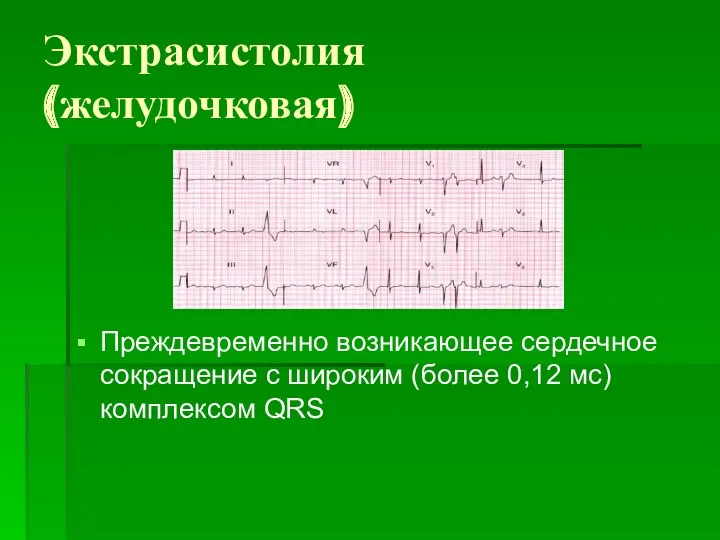Экстрасистолия (желудочковая) Преждевременно возникающее сердечное сокращение с широким (более 0,12 мс) комплексом QRS