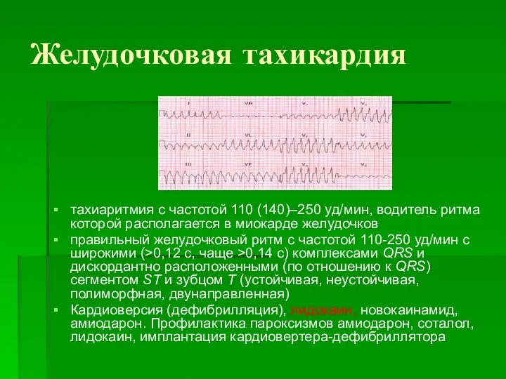 Желудочковая тахикардия тахиаритмия с частотой 110 (140)–250 уд/мин, водитель ритма которой располагается в