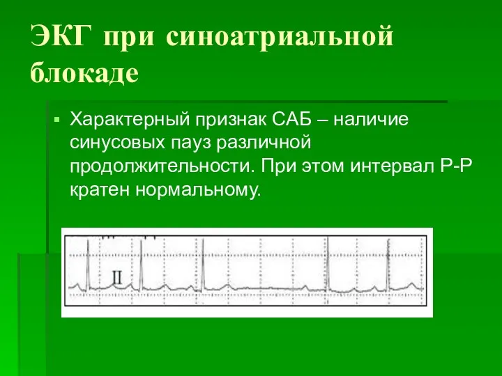 ЭКГ при синоатриальной блокаде Характерный признак САБ – наличие синусовых пауз различной продолжительности.