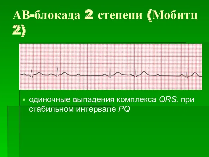 АВ-блокада 2 степени (Мобитц 2) одиночные выпадения комплекса QRS, при стабильном интервале PQ