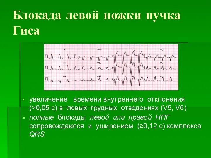 Блокада левой ножки пучка Гиса увеличение времени внутреннего отклонения (>0,05 с) в левых