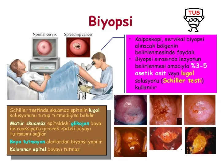 Biyopsi Kolposkopi, servikal biyopsi alınacak bölgenin belirlenmesinde faydalı. Biyopsi sırasında lezyonun belirlenmesi amacıyla