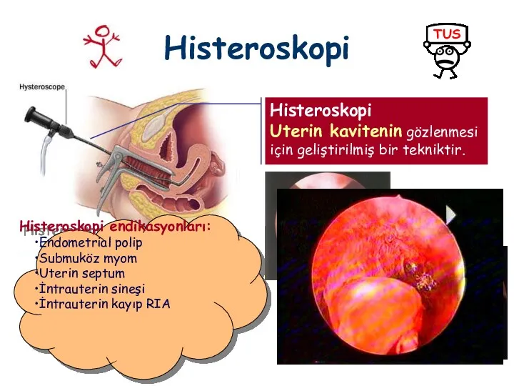 Histeroskopi Histeroskopi Uterin kavitenin gözlenmesi için geliştirilmiş bir tekniktir. Histeroskopi