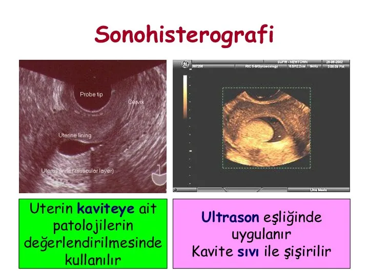 Sonohisterografi Uterin kaviteye ait patolojilerin değerlendirilmesinde kullanılır Ultrason eşliğinde uygulanır Kavite sıvı ile şişirilir