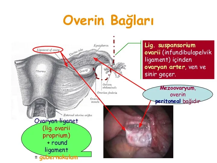 Overin Bağları Lig. suspansorium ovarii (infundibulopelvik ligament) içinden ovaryan arter, ven ve sinir