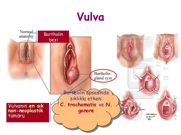 Vulva Bartholin bezi Vulvanın en sık non-neoplastik tümörü Bartholin apsesinde sıklıkla etken: C.