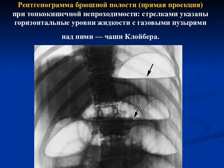Рентгенограмма брюшной полости (прямая проекция) при тонкокишечной непроходимости: стрелками указаны горизонтальные уровни жидкости