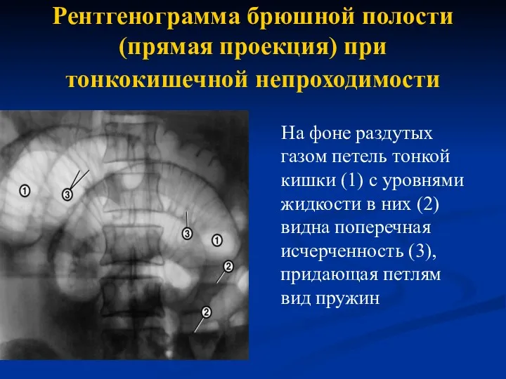 Рентгенограмма брюшной полости (прямая проекция) при тонкокишечной непроходимости На фоне раздутых газом петель