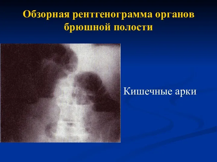 Обзорная рентгенограмма органов брюшной полости Кишечные арки