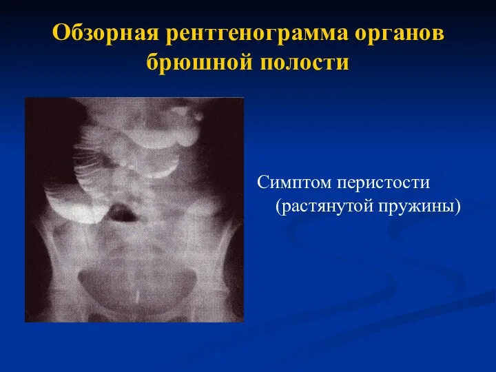 Обзорная рентгенограмма органов брюшной полости Симптом перистости (растянутой пружины)