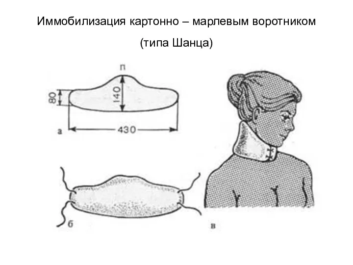 Иммобилизация картонно – марлевым воротником (типа Шанца)